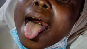 Read more about the article Why is diphtheria still a deadly threat in Nigeria?
