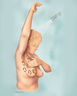 Breast cancer
